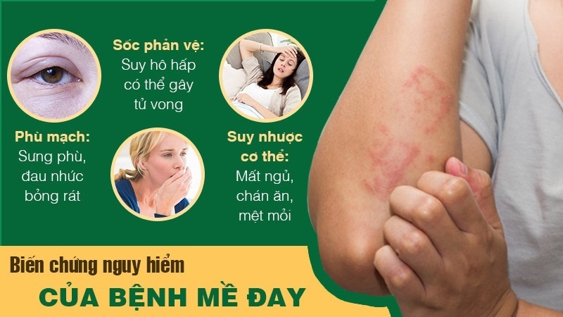 Biến chứng bệnh mề đay, mẩn ngứa