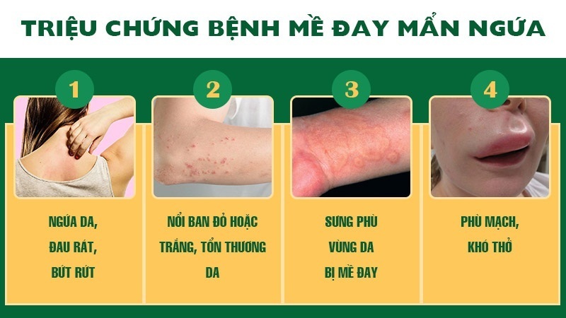 Triệu chứng bệnh mề đay, mẩn ngứa