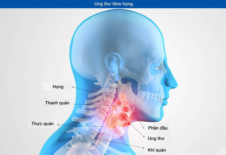 Gây bệnh ung thư vòm họng