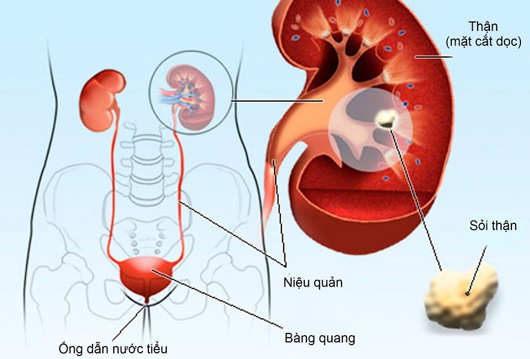 Cách điều trị sỏi thận 4mm là vấn đề được nhiều người quan tâm