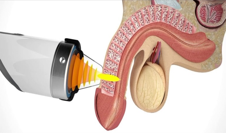 Điều trị rối loạn cương dương bằng sóng xung kích không gây tác dụng phụ