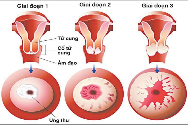 Huyết trắng màu xanh, chảy máu âm đạo… là những biểu hiện của ung thư cổ tử cung