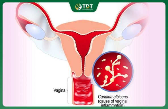 Nhiễm Nấm Candida Có Nguy Hiểm Không? Cách Phòng Bệnh Hiệu Quả