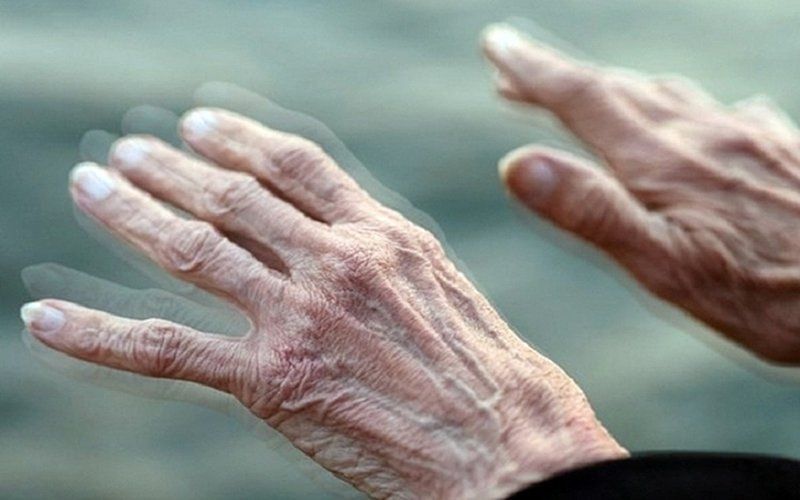 Bệnh lý Parkinson với biểu hiện suy giảm cân nặng