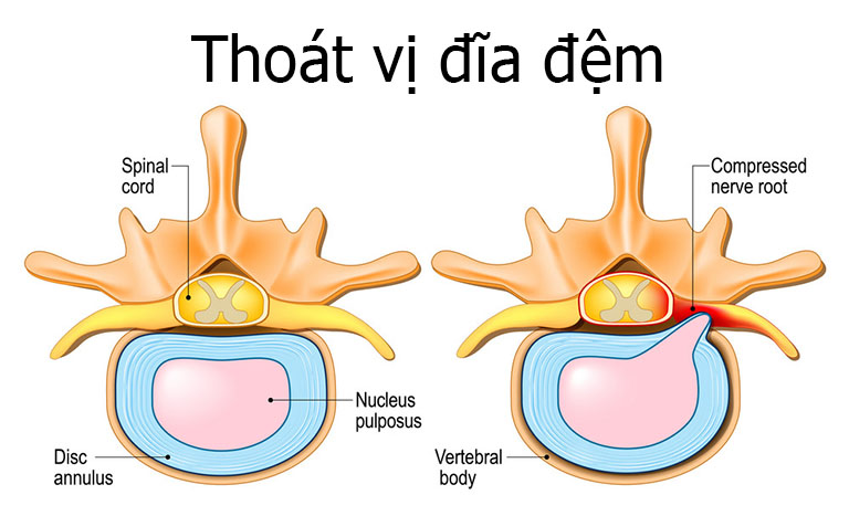 Thoát vị đĩa đệm