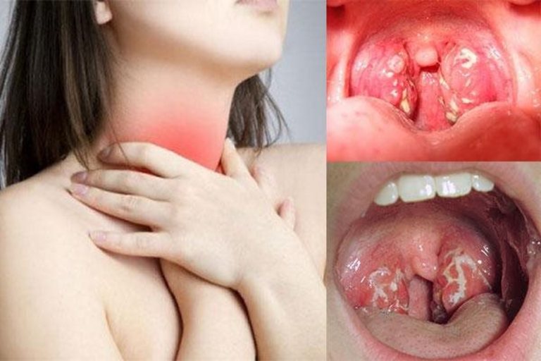 Viêm họng hạt có mủ là bệnh thường gặp ở mọi đối tượng