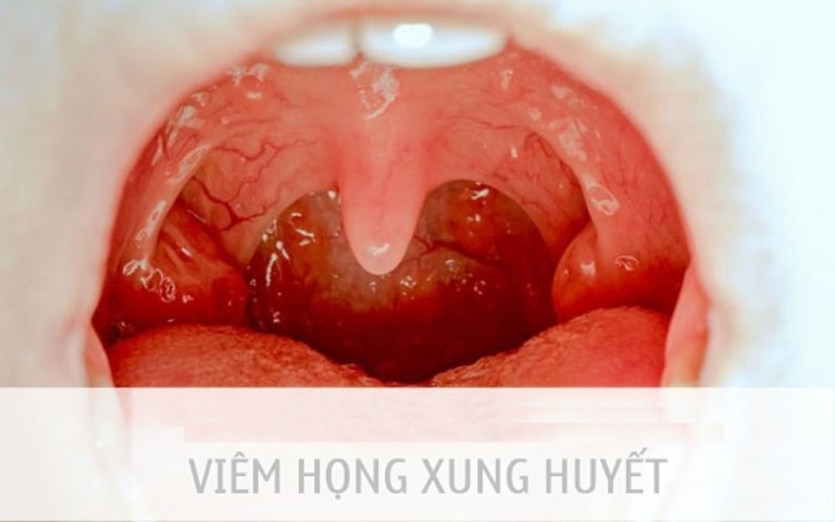 Viêm họng xung huyết là bệnh lý phổ biến ở các lứa tuổi